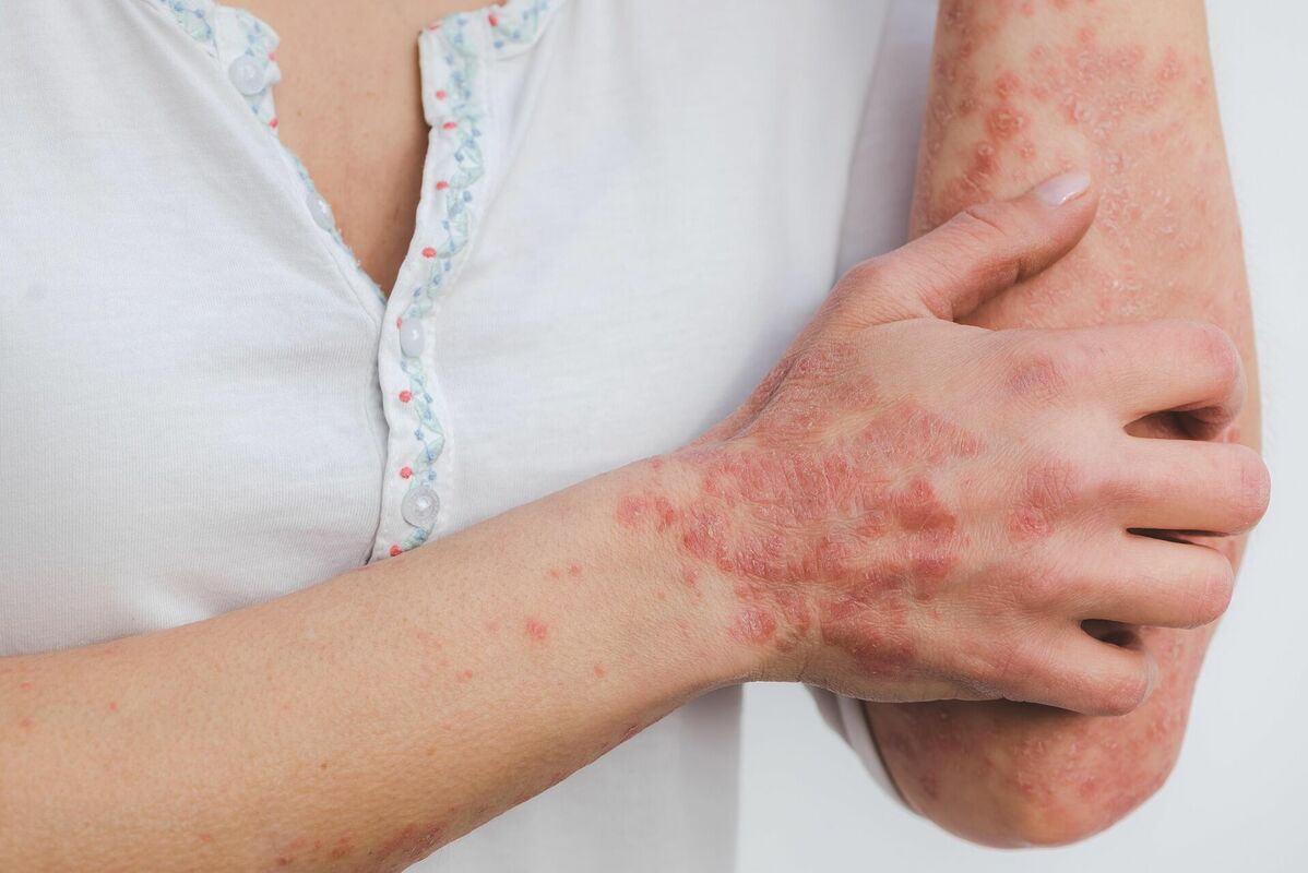 Psoriāze. Foto: Pixabay Psoriāze. Foto: Pixabay