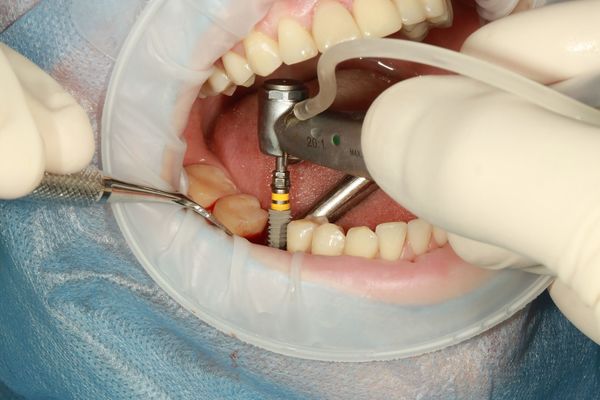Zobu implanta skrūves ievietošana, foto no Pixabay