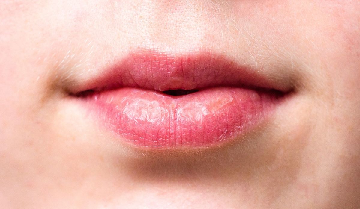Sasprēgājušas lūpas, foto Pixabay