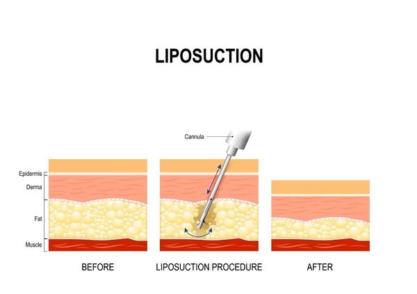 Liposkacija - ķermeņa formas korekcija (Plastiskās ķirurģijas klīnika)
