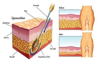 Liposkacija - ķermeņa formas korekcija (Plastiskās ķirurģijas klīnika)
