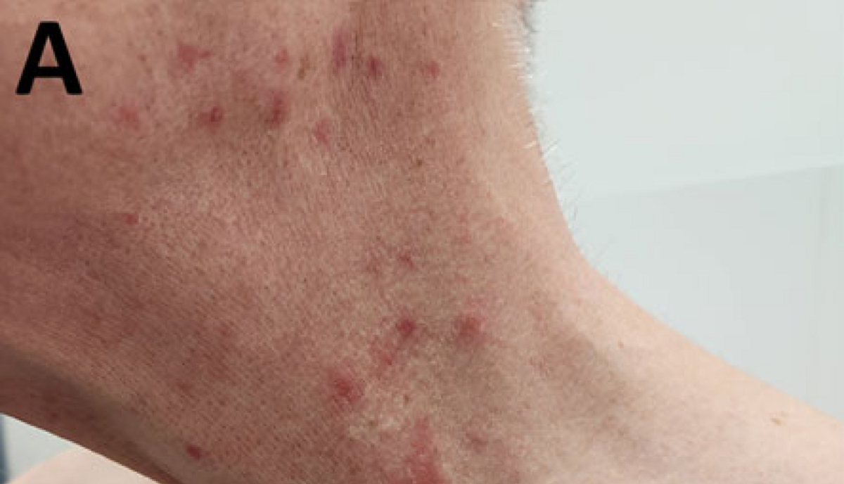 Dermatofilioze. Foto: SPKC